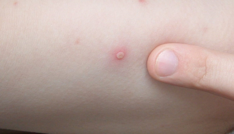 جدري القرود